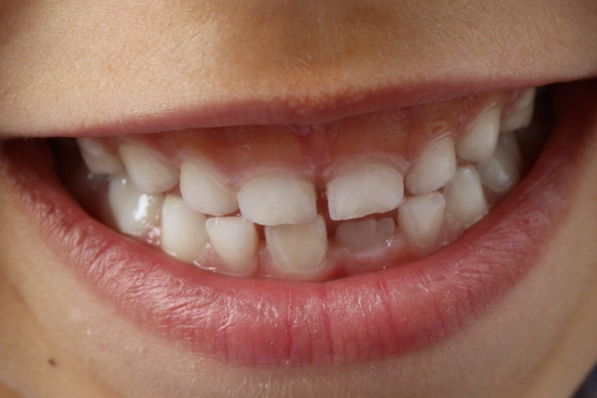 Dental Implants Image 2
