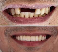 Dental Implants Image 1