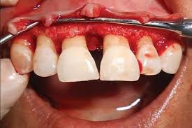 Dental Implants Image 1