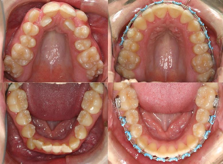 Dental Implants Image 3